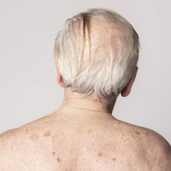 Neck Pain